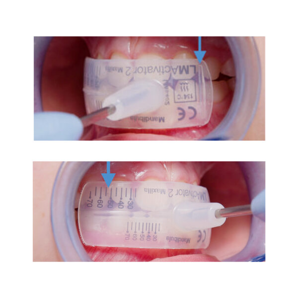 LM-Activator 2 OrthoSizer - Image 2